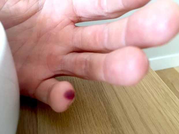 Blood Blister on Dave's pinky finger